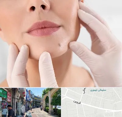 برداشتن خال در خیابان قزوین