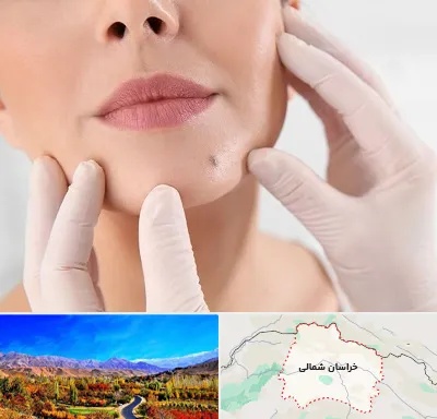 برداشتن خال در خراسان شمالی