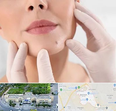 برداشتن خال در نسیم شهر