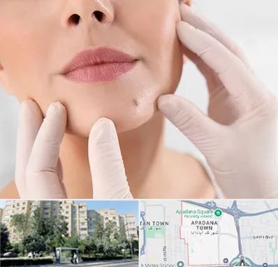 برداشتن خال در آپادانا