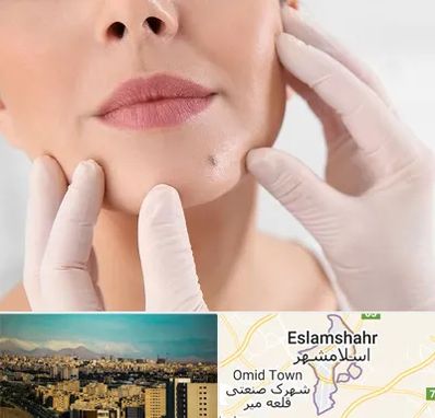 برداشتن خال در اسلامشهر