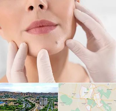 برداشتن خال در شهریار