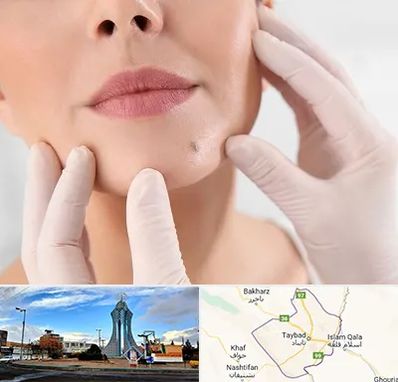 برداشتن خال در تایباد