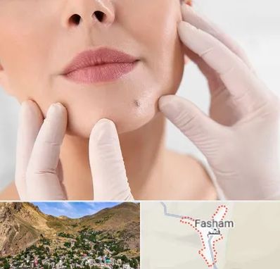 برداشتن خال در فشم