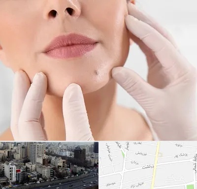 برداشتن خال در زرتشت