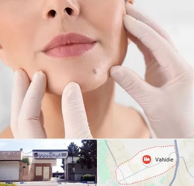 برداشتن خال در وحیدیه شهریار