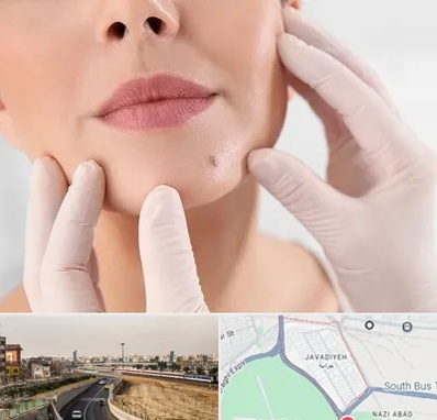 برداشتن خال در جوادیه