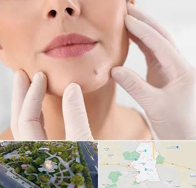 برداشتن خال در کاشمر