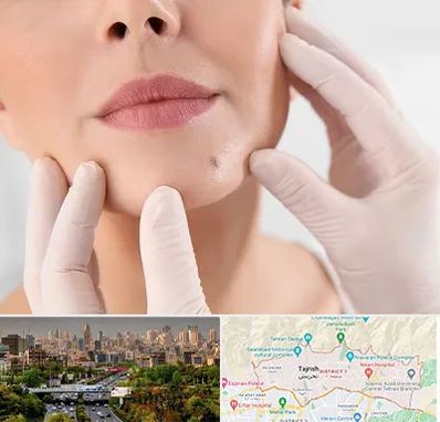 برداشتن خال در منطقه 1 تهران