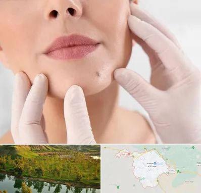 برداشتن خال در بهبهان