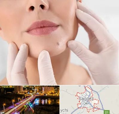 برداشتن خال در سقز