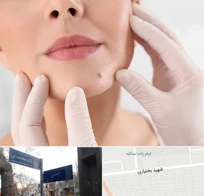 برداشتن خال در سی متری جی