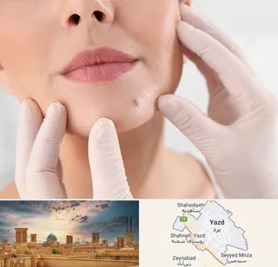 برداشتن خال در یزد