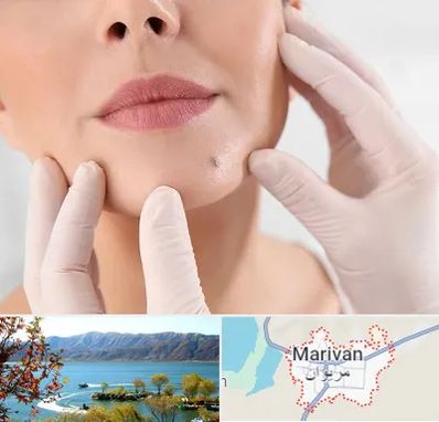 برداشتن خال در مریوان