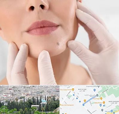 برداشتن خال در محلاتی شیراز