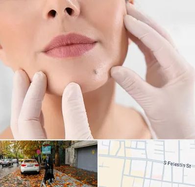 برداشتن خال در خیابان فلسطین