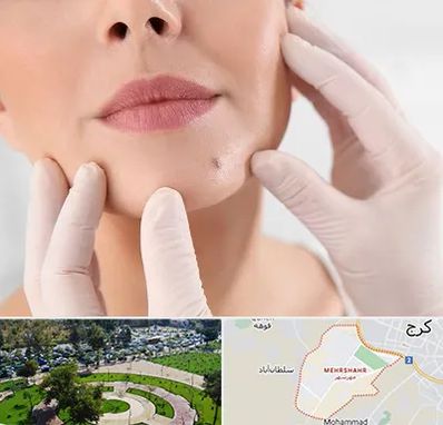 برداشتن خال در مهرشهر کرج 