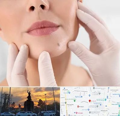 برداشتن خال در میدان حر