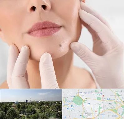 برداشتن خال در منطقه 16 تهران