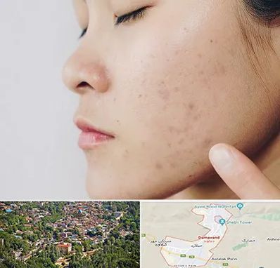 دکتر جوش صورت در دماوند