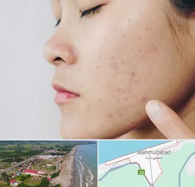 دکتر جوش صورت در محمودآباد