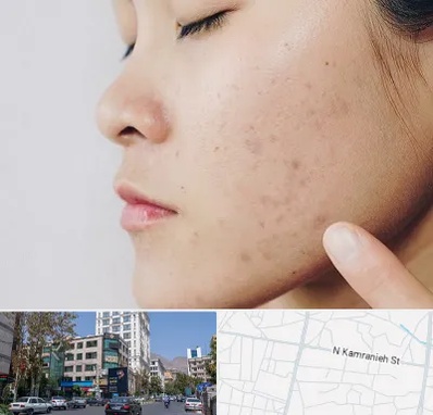 دکتر جوش صورت در کامرانیه