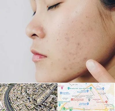 دکتر جوش صورت در شهرک غرب مشهد