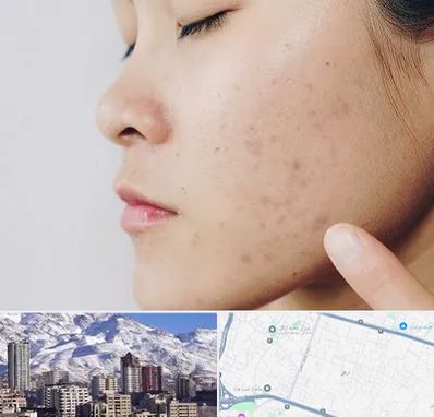 دکتر جوش صورت در ازگل