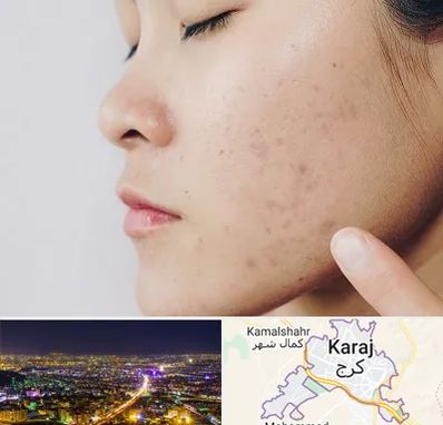 دکتر جوش صورت در کرج