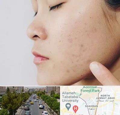 دکتر جوش صورت در شهران 