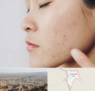 دکتر جوش صورت در اسفراین