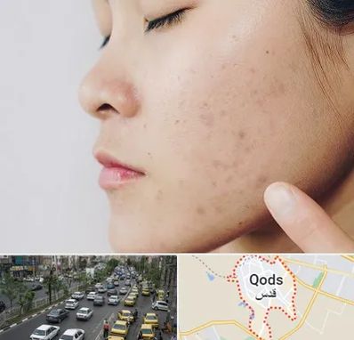 دکتر جوش صورت در شهر قدس