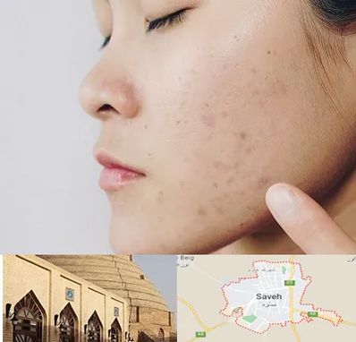 دکتر جوش صورت در ساوه