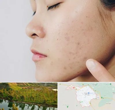 دکتر جوش صورت در بهبهان