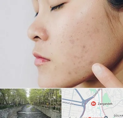 دکتر جوش صورت در زرگنده
