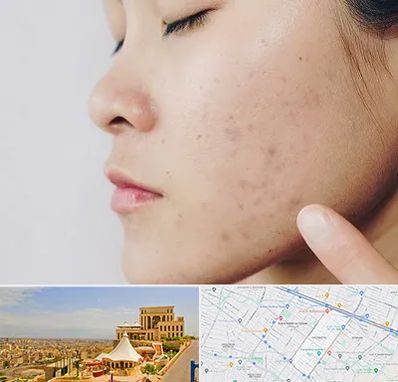 دکتر جوش صورت در هاشمیه مشهد