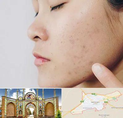 دکتر جوش صورت در سمنان