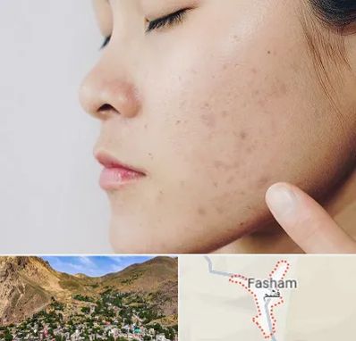 دکتر جوش صورت در فشم