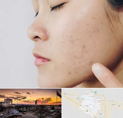 دکتر جوش صورت در قوچان