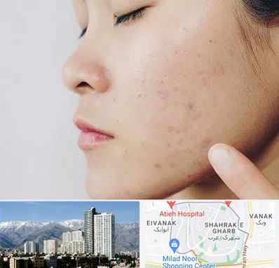 دکتر جوش صورت در شهرک غرب 