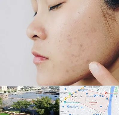 دکتر جوش صورت در گلستان اهواز