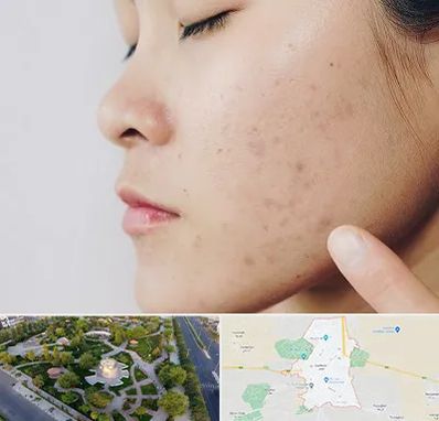 دکتر جوش صورت در کاشمر