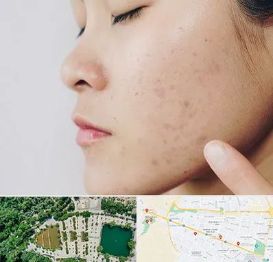 دکتر جوش صورت در وکیل آباد مشهد