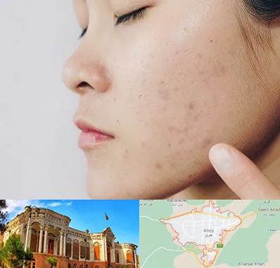 دکتر جوش صورت در خوی