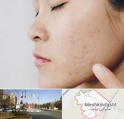 دکتر جوش صورت در مشکین دشت