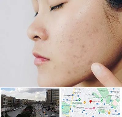 دکتر جوش صورت در بلوار فردوسی مشهد