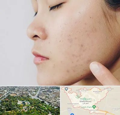 دکتر جوش صورت در شهرکرد