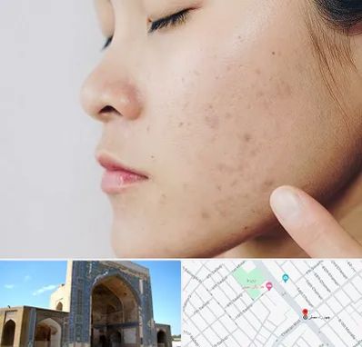 دکتر جوش صورت در مصلی مشهد