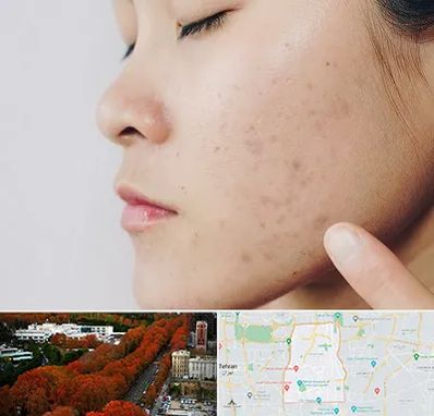 دکتر جوش صورت در منطقه 6 تهران