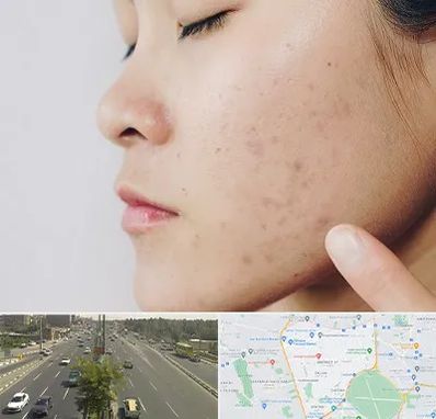 دکتر جوش صورت در منطقه 17 تهران